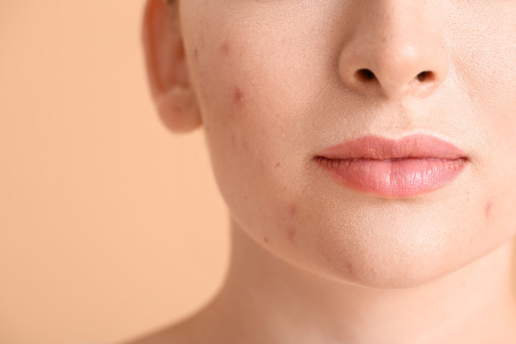 What Causes Acne Before Your Period How To Deal With It Allprettybits